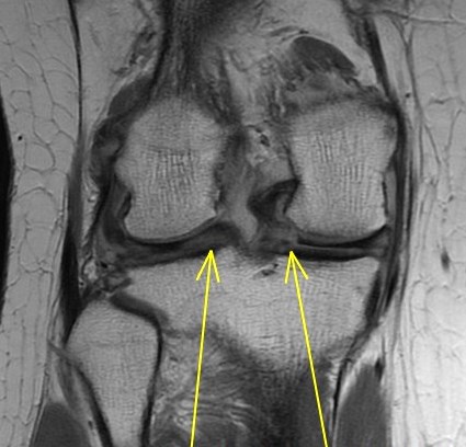 Figure 6 for case Meniscus tears ( RID2762 )